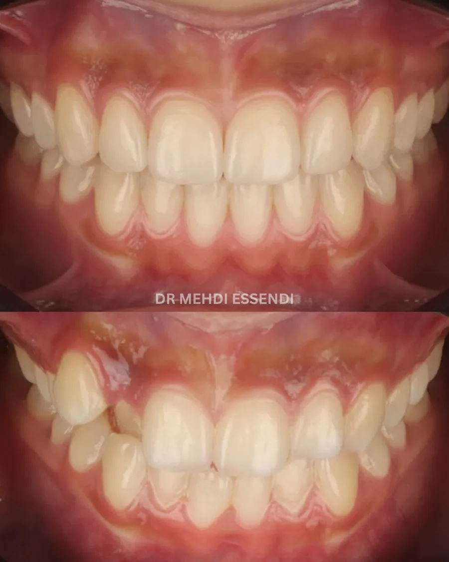 Sourire d’une patiente en suivi orthodontique